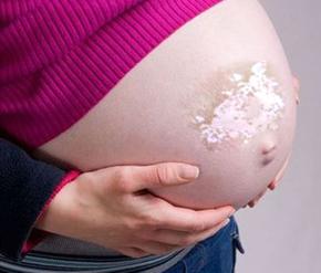 孕妇患上白癜风应该怎么护理